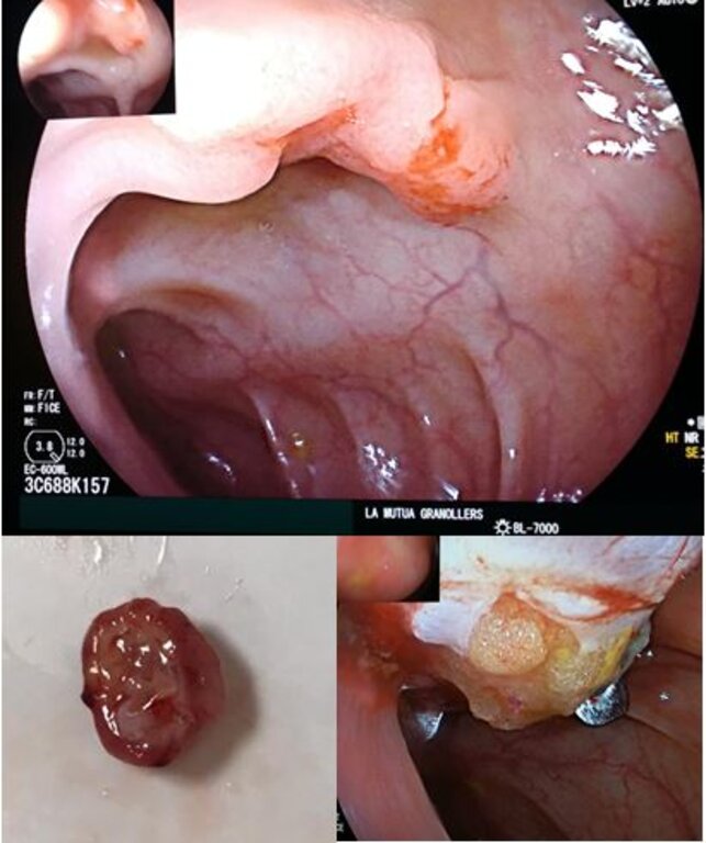Primeres intervencions de Resecció Endoscòpica Transmural